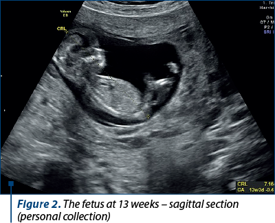 Figure 2. The fetus at 13 weeks – sagittal section (personal collection)