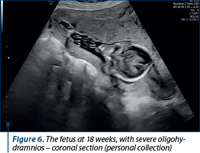 Figure 6. The fetus at 18 weeks, with severe oligo­hy­dramnios – coronal section (personal collection)