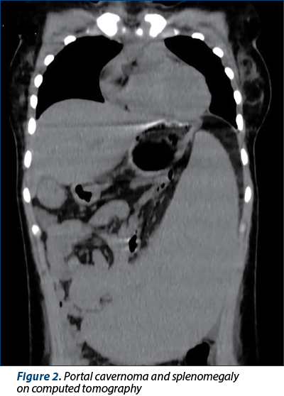 Figure 2. Portal cavernoma and splenomegaly  on computed tomography