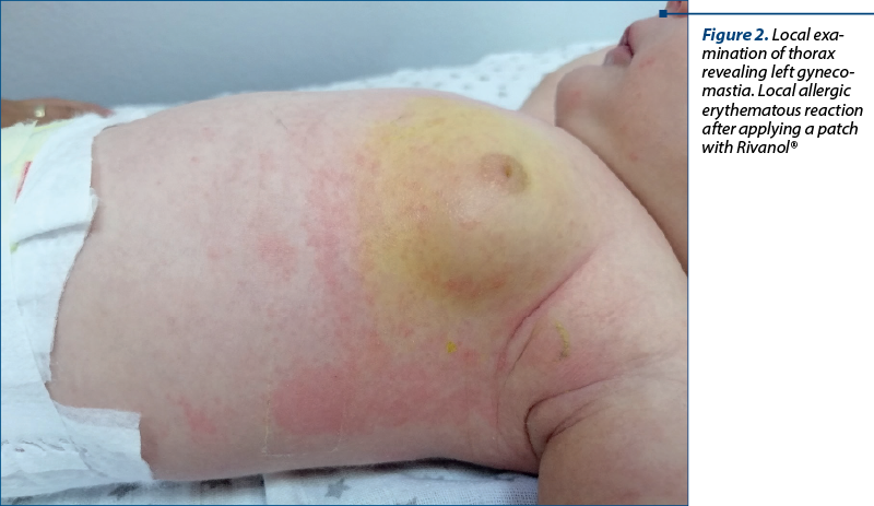 Figure 2. Local exa­mi­na­tion of thorax revealing left gyne­co­mas­tia. Local allergic erythematous reaction after applying a patch with Rivanol®