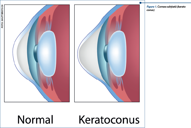 Figura 1. Cornee subţiată (keratoconus)