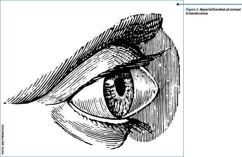 Figura 2. Aspectul bombat al corneei în keratoconus