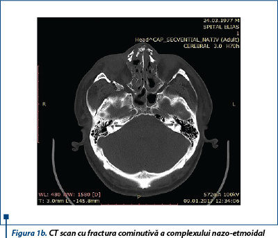 Figura 1b. CT scan cu fractura cominutivă a complexului nazo-etmoidal