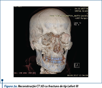 Figura 2a. Reconstrucție CT 3D cu fractura de tip Lefort III