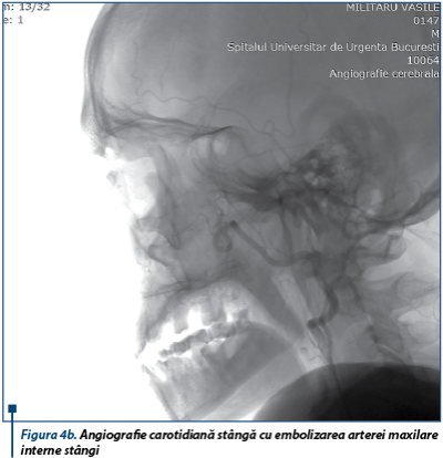 Figura 4b. Angiografie carotidiană stângă cu embolizarea arterei maxilare interne stângi