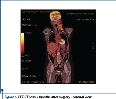 Figure 6. PET-CT scan 2 months after surgery - coronal view