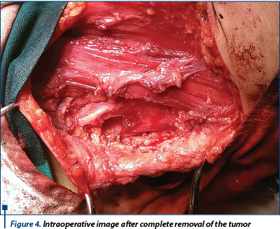 Figure 4. Intraoperative image after complete removal of the tumor