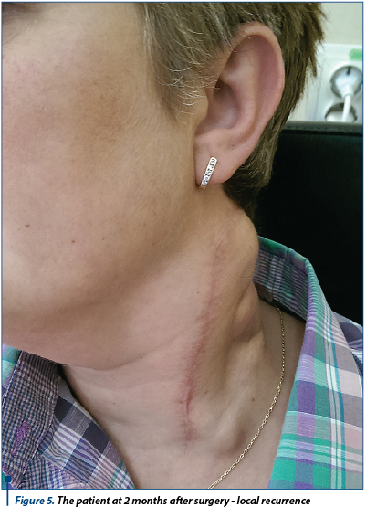 Figure 5. The patient at 2 months after surgery - local recurrence
