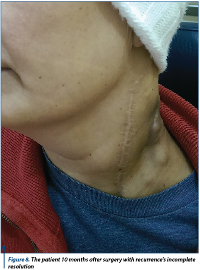 Figure 8. The patient 10 months after surgery with recurrence’s incomplete resolution 