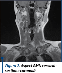 Figura 2. Aspect RMN cervical - secțiune coronală