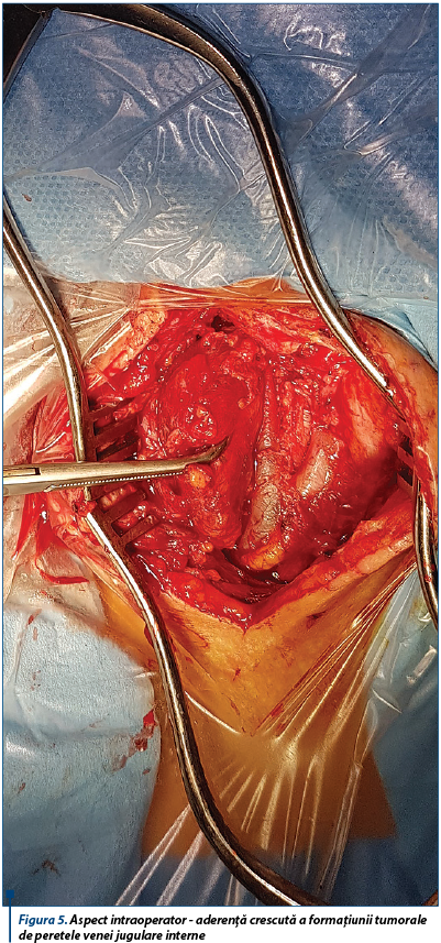 Figura 5. Aspect intraoperator - aderență crescută a formațiunii tumorale de peretele venei jugulare interne