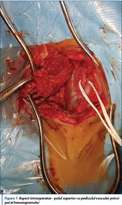 Figura 7. Aspect intraoperator - polul superior cu pediculul vascular principal al hemangiomului
