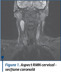 Figura 1. Aspect RMN cervical - secțiune coronală