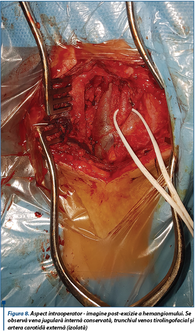 Figura 8. Aspect intraoperator - imagine post-excizie a hemangiomului. Se observă vena jugulară internă conservată, trunchiul venos tirolingofacial și artera carotidă externă (izolată)