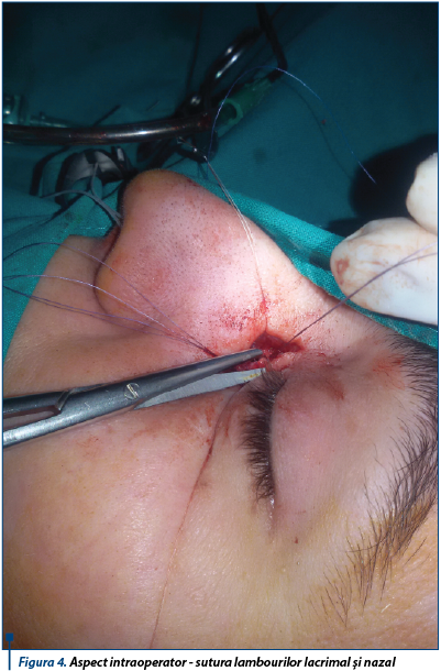 Figura 4. Aspect intraoperator - sutura lambourilor lacrimal și nazal 