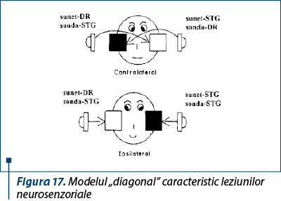 Figura 17. Modelul „diagonal” caracteristic leziunilor neurosenzoriale