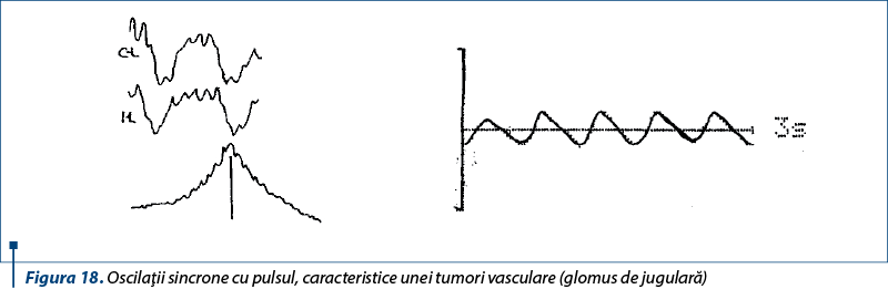 Figura 18. Oscilaţii sincrone cu pulsul, caracteristice unei tumori vasculare (glomus de jugulară)
