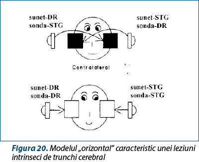 Figura 20. Modelul „orizontal” caracteristic unei leziuni intrinseci de trunchi cerebral