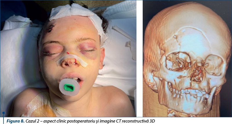 Figura 8. Cazul 2 – aspect clinic postoperatoriu şi imagine CT reconstructivă 3D