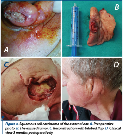 Figure 4. Squamous cell carcinoma of the external ear. A. Preoperative photo. B. The excised tumor. C. Reconstruction with bilobed flap. D. Clinical view 3 months postoperatively