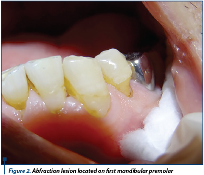 Figure 2. Abfraction lesion located on first mandibular premolar