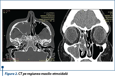 Figura 2. CT pe regiunea maxilo-etmoidală