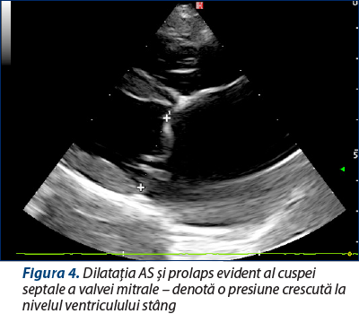 Figura 4. Dilataţia AS şi prolaps evident al cuspei septale a valvei mitrale – denotă o presiune crescută la nivelul ventriculului stâng