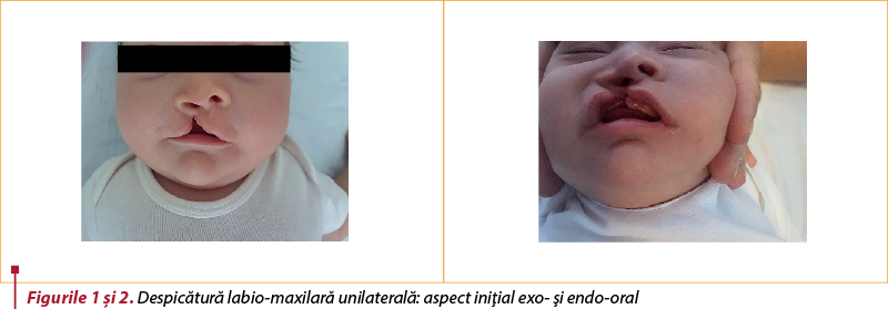 Figurile 1 şi 2. Despicătură labio-maxilară unilaterală: aspect iniţial exo- şi endo-oral
