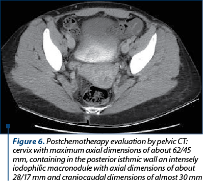 Figure 6. Postchemotherapy evaluation by pelvic CT: cervix with maximum axial dimensions of about 62/45 mm, containing in the posterior isthmic wall an intensely iodophilic macronodule with axial dimensions of about 28/17 mm and craniocaudal dimensions of almost 30 mm 