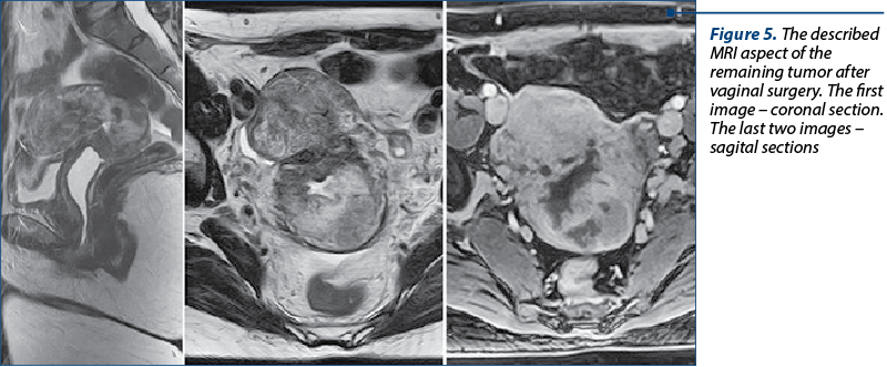 Figure 5. The described MRI aspect of the remaining tumor after vaginal surgery. The first image – coronal section. The last two images – sagital sections