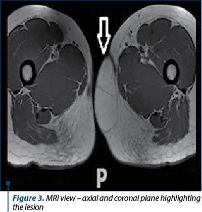 Figure 3. MRI view – axial and coronal plane highlighting the lesion