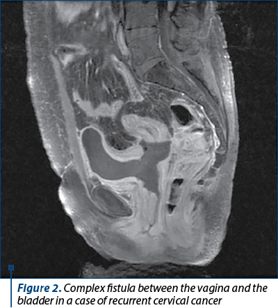 Figure 2. Complex fistula between the vagina and the bladder in a case of recurrent cervical cancer