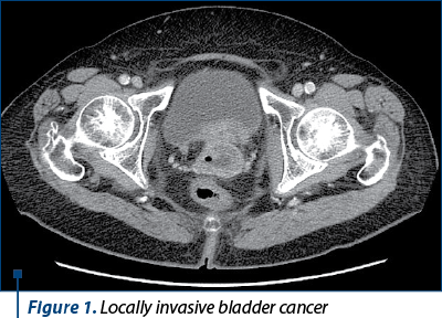 Figure 1. Locally invasive bladder cancer