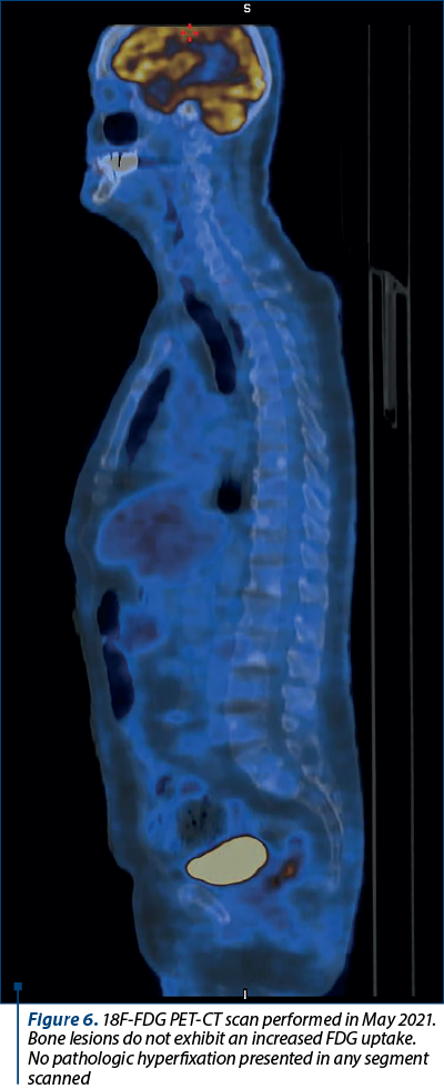 Figure 6. 18F-FDG PET-CT scan performed in May 2021. Bone lesions do not exhibit an increased FDG uptake. No pathologic hyperfixation presented in any segment scanned