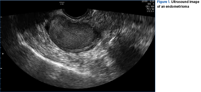 Figure 1. Ultrasound image  of an endometrioma