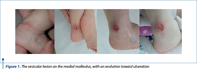 Figure 1. The vesicular lesion on the medial malleolus, with an evolution toward ulceration