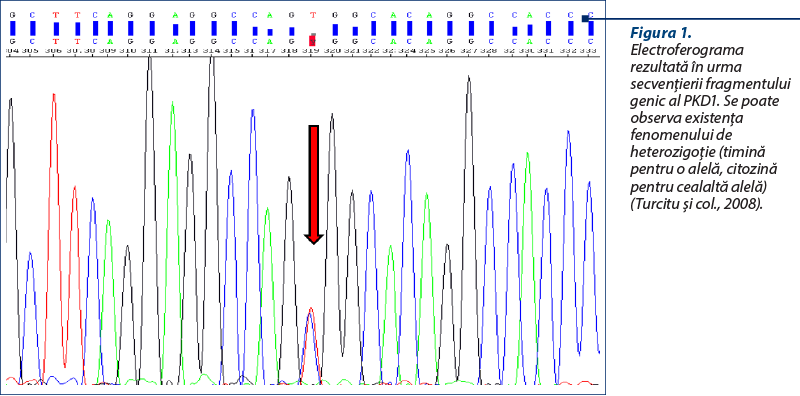 Figura 1. Electroferograma rezultată în urma secvenţierii fragmentului genic al PKD1. Se poate observa existenţa fenomenului de heterozigoţie (timină pentru o alelă, citozină pentru cealaltă alelă) (Turcitu şi col., 2008).