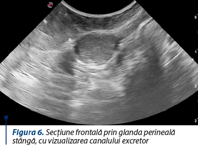 Figura 6. Secţiune frontală prin glanda perineală stângă, cu vizualizarea canalului excretor