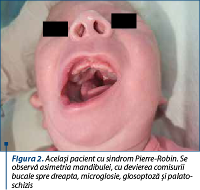 Figura 2. Acelaşi pacient cu sindrom Pierre-Robin. Se observă asimetria mandibulei, cu devierea comisurii bucale spre dreapta, microglosie, glosoptoză şi palato­schizis