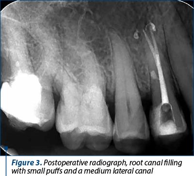 Figure 3. Postoperative radiograph, root canal filling with small puffs and a medium lateral canal