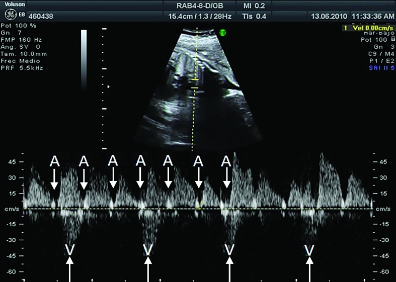 Figura 3. BAV complet. Ecocardiografia fetală evidenţiază disociaţia dintre contracţiile atriale şi ventriculare (înregistrare Doppler)