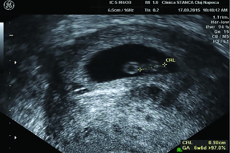 Figure 1. Transvaginal ultrasound image. Intrauterine gestational sac, with visible embryo and Yolk Sac, crown-rump length corresponding to 6 weeks + 6 days 