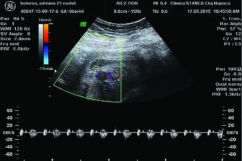 Figure 2. Transabdominal ultrasound image. Intrauterine gestational sac, with visible embryo and cardiac activity detectable by Doppler ultrasound