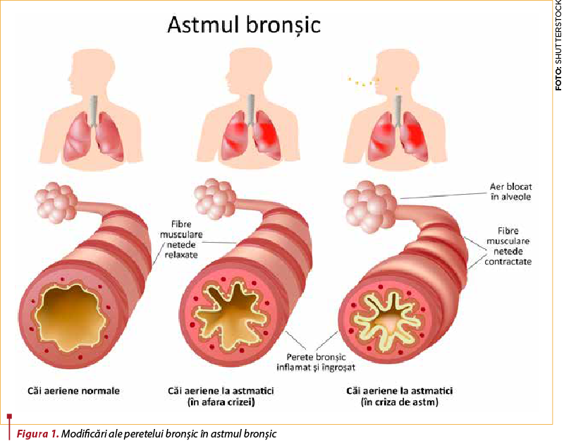 Figura 1. Modificări ale peretelui bronşic în astmul bronşic