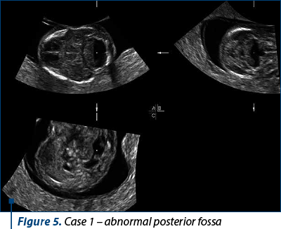 Figure 5. Case 1 – abnormal posterior fossa 