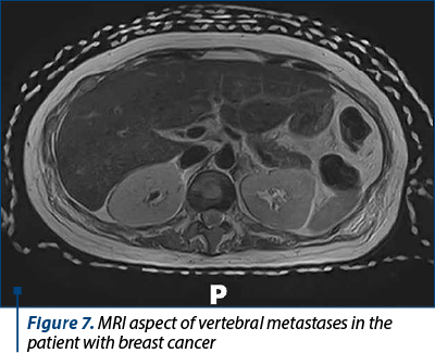 Figure 7. MRI aspect of vertebral metastases in the patient with breast cancer