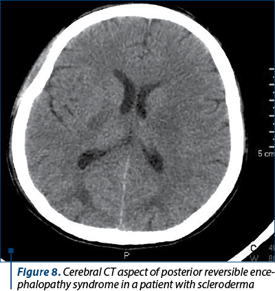 Figure 8. Cerebral CT aspect of posterior reversible ence­phalopathy syndrome in a patient with scleroderma
