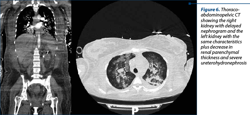 Figure 6. Thoraco-abdominopelvic CT showing the right kidney with delayed nephrogram and the left kidney with the same characteristics plus decrease in renal parenchymal thickness and severe ureterohydronephrosis
