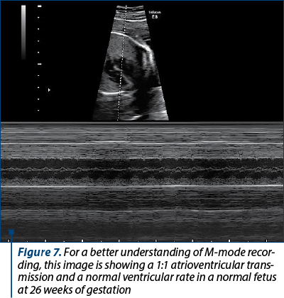 Figure 7. For a better understanding of M-mode recor­ding, this image is showing a 1:1 atrioventricular trans­mis­sion and a normal ventricular rate in a normal fetus at 26 weeks of gestation 