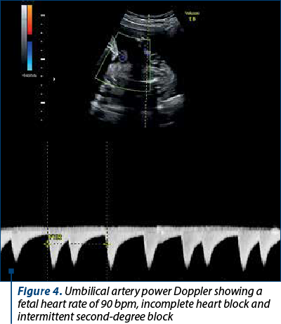 Figure 4. Umbilical artery power Doppler showing a fetal heart rate of 90 bpm, incomplete heart block and intermittent second-degree block